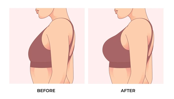 Breast Fillers vs Breast Augmentation: What You Need to Know In 2026 1 breast-fillers-vs-breast-augmentation