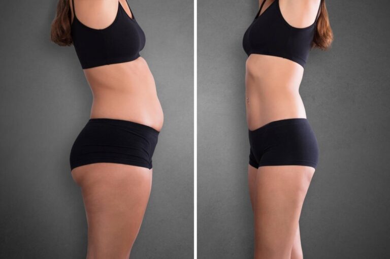 exilis before after at glojas specialist clinic