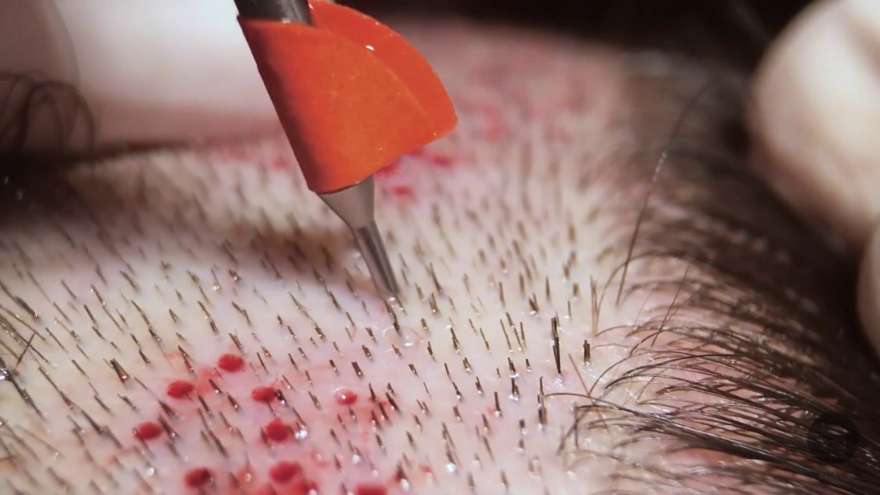 Hair Transplant Glossary: Every Medical Terms You Should Know 1 hair transplant glossary