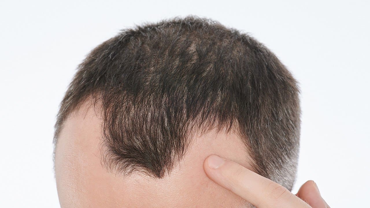 Hair Transplant Myths Debunked: What You Need to Know 1 hair transplant myths