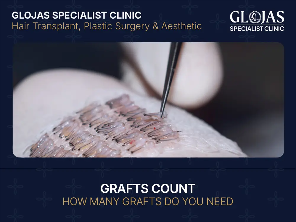 how many grafts do you need for hair transplant