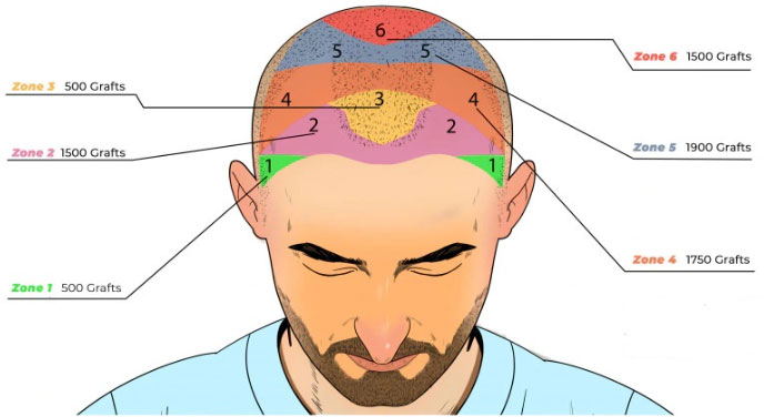 How Many Grafts Do You Need for Hair Transplant? 2 how many grafts do you need graft count
