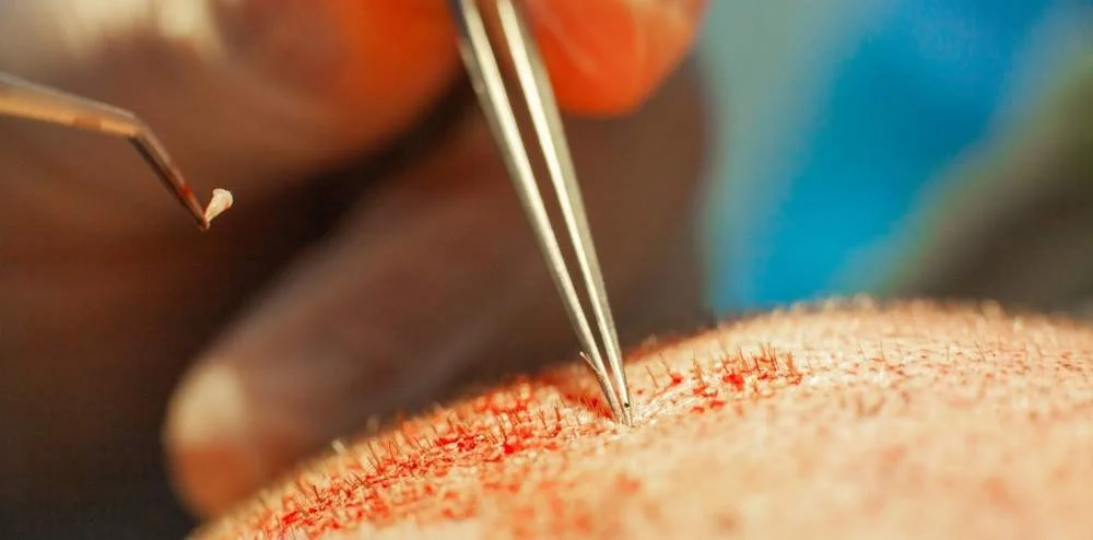 How Many Grafts Do You Need for Hair Transplant? 1 how many grafts do you need