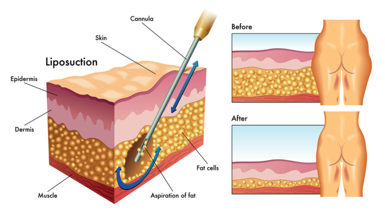 liposuction safe fat removal and improved body contour by board-certified surgeons