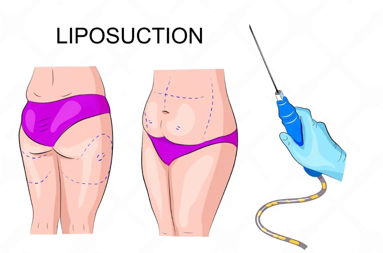 Liposuction Malaysia: Everything You Need To Know Before Surgery 2 liposuction malaysia