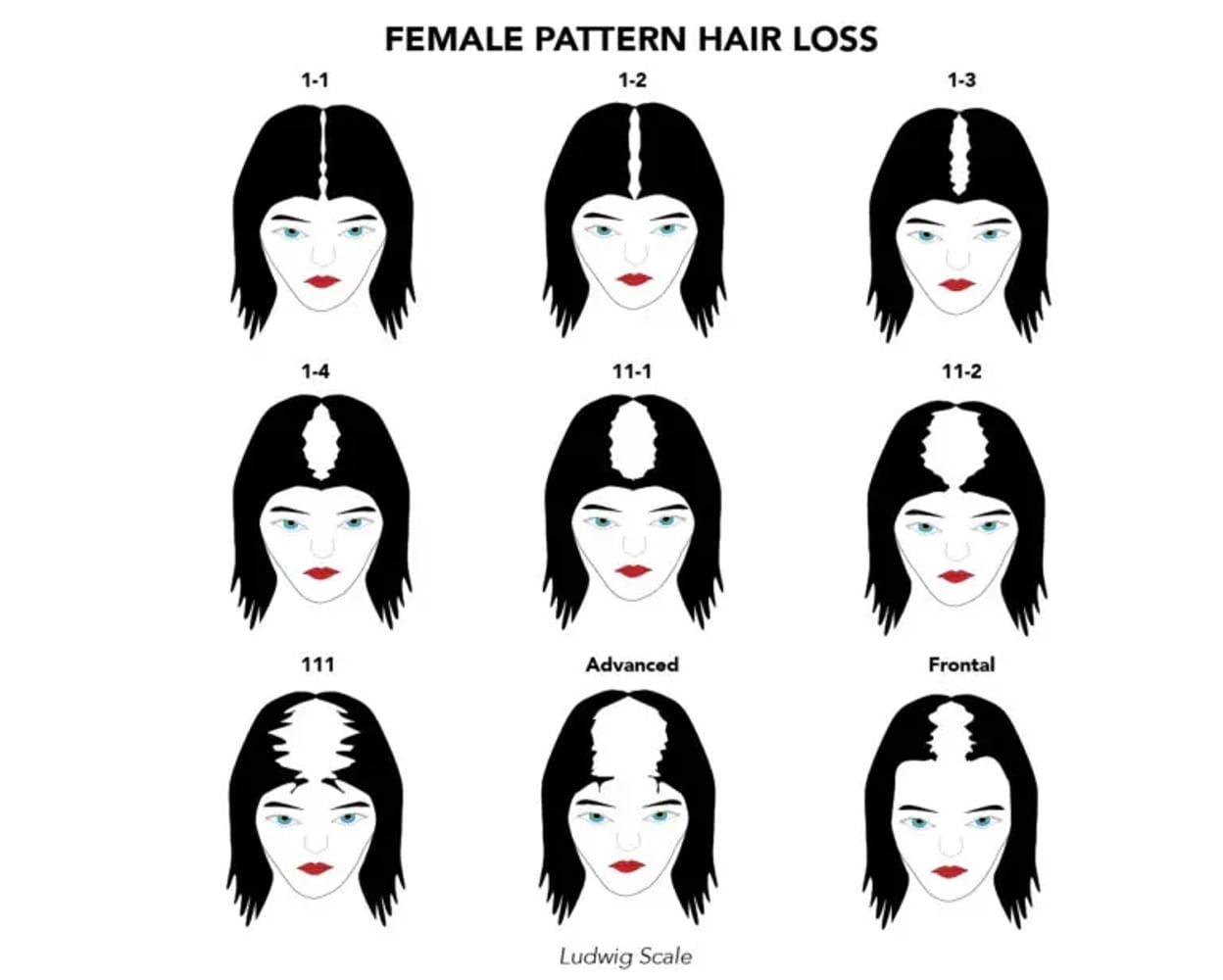The Ludwig Scale: Understanding Female Pattern Hair Loss 1 ludwig-scale-for-female-hair-loss-stages
