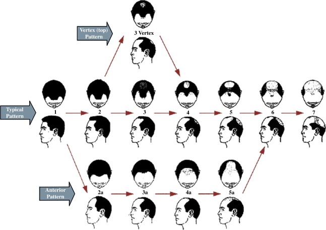 male pattern baldness chart