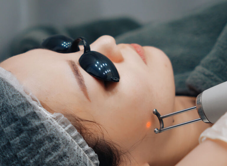 Pico Laser treatment on woman’s face for acne scars and pigmentation removal