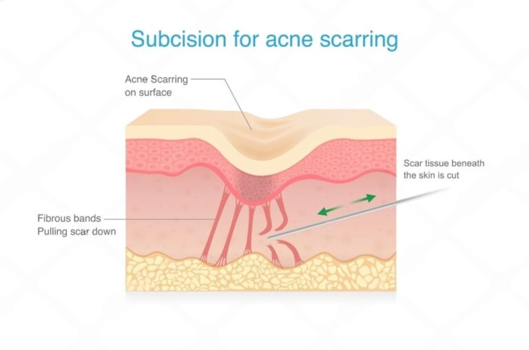 Subcision for Acne Scars: How It Works & Recovery