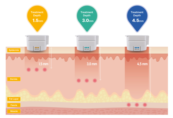 HIFU works in the skin