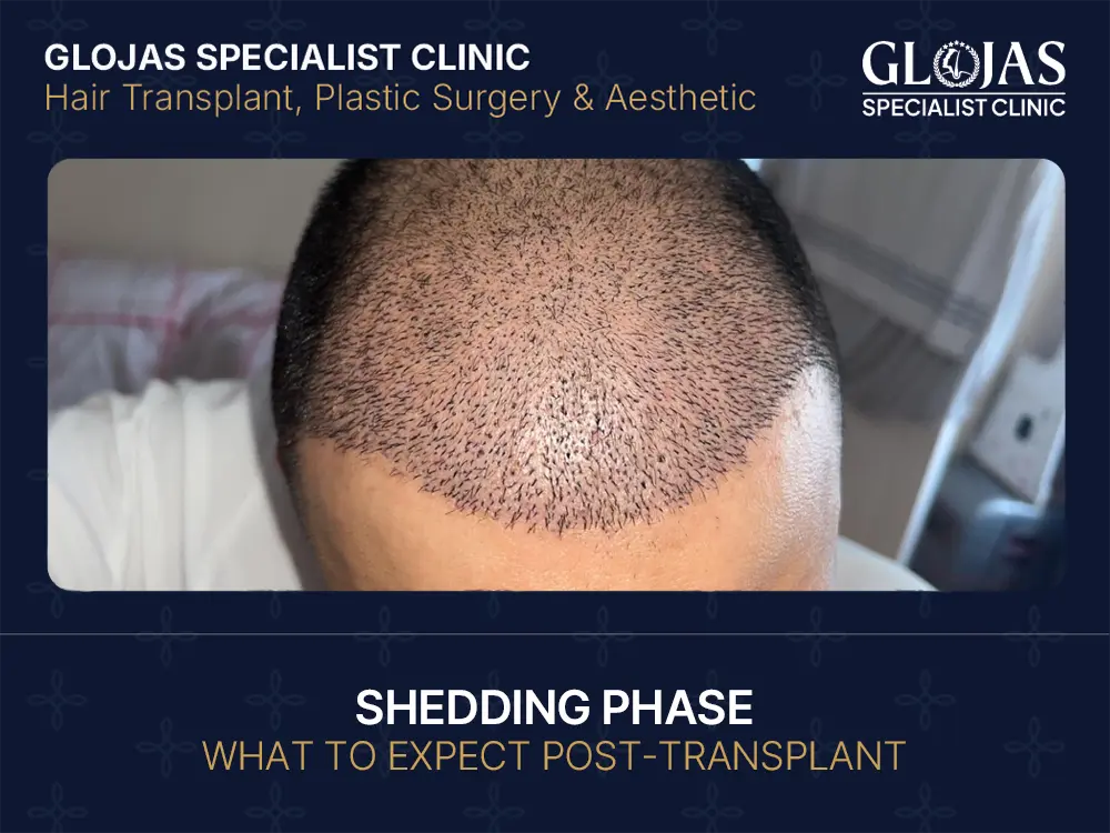 Shedding Phase What to Expect Post-Transplant
