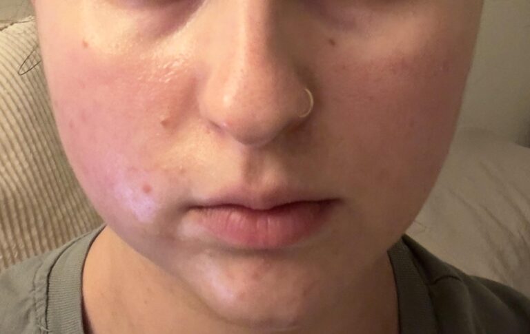 buccal fat removal before