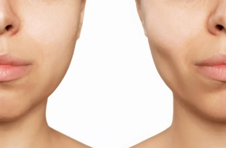 buccal fat removal near me KL