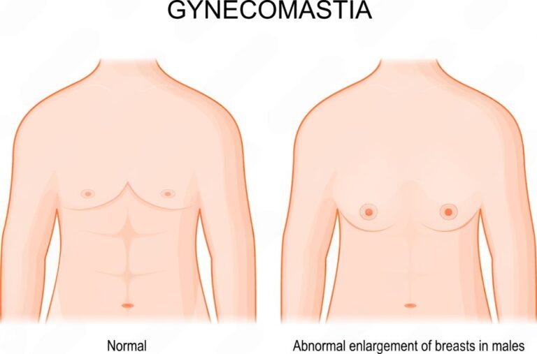 how gynecomastia work | GLOJAS