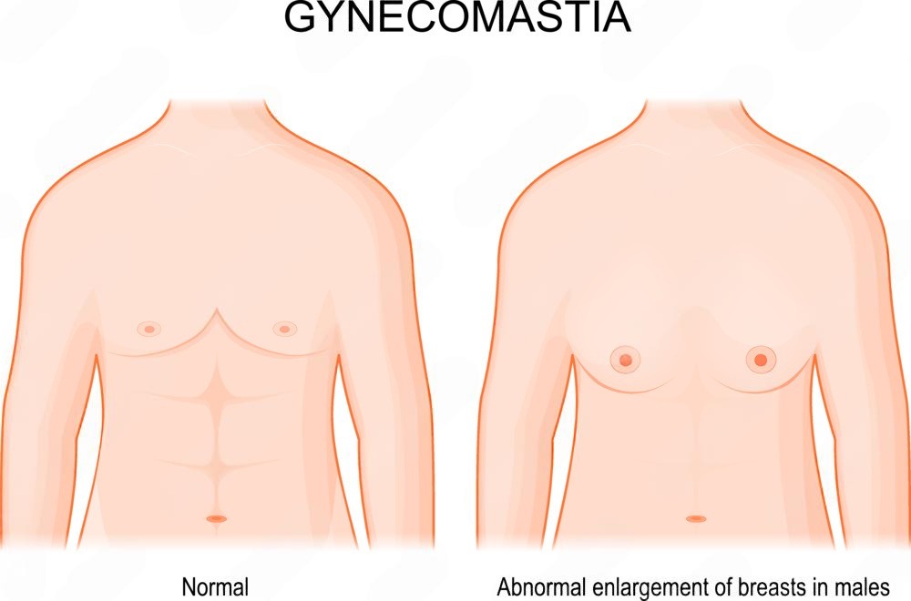 how gynecomastia work | GLOJAS