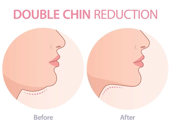hifu double chin removal