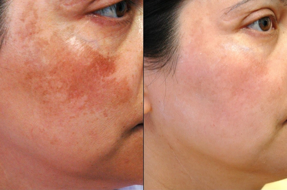 Hyperpigmentation Malaysia Guide: Causes, Treatments & Clear Skin 1 hyperpigmentation vs. pigmentation