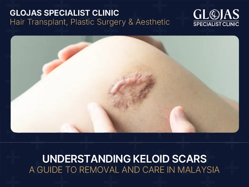 Understanding Keloid Scars: A Guide to Removal and Care In Malaysia 5 keloid scar treatment in malaysia