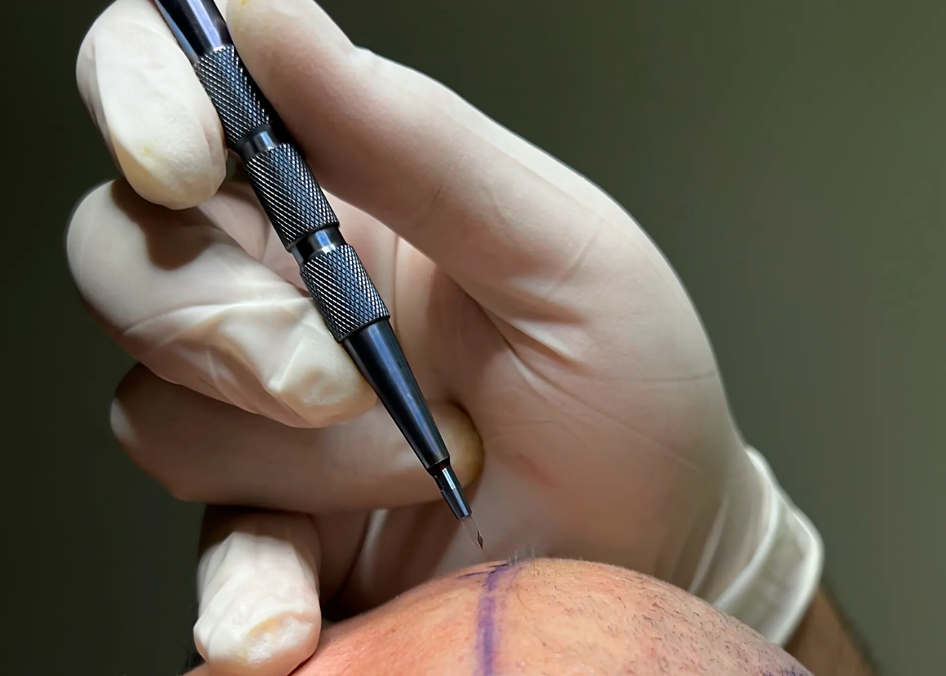 sapphire hair transplant at glojas