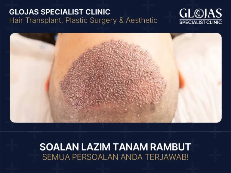 soalan lazim tanam rambut di malaysia