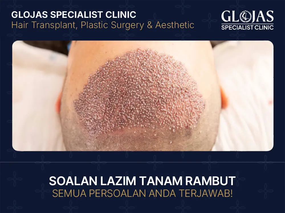 soalan lazim tanam rambut di malaysia