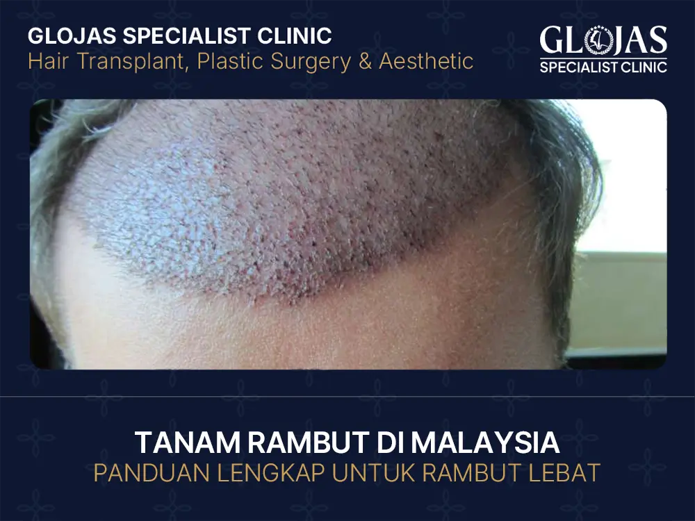 tanam rambut di malaysia