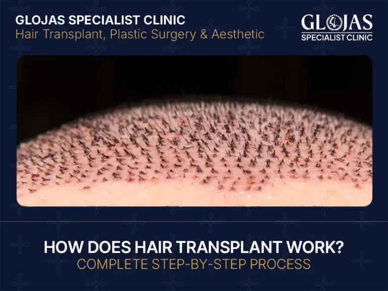 Blogs 26 How Does Hair Transplant Work