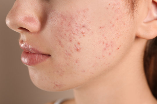 acne treatment pimple acne in malaysia