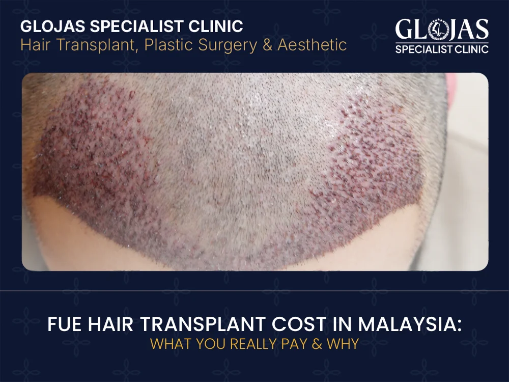 fue-hair-transplant-cost-malaysia