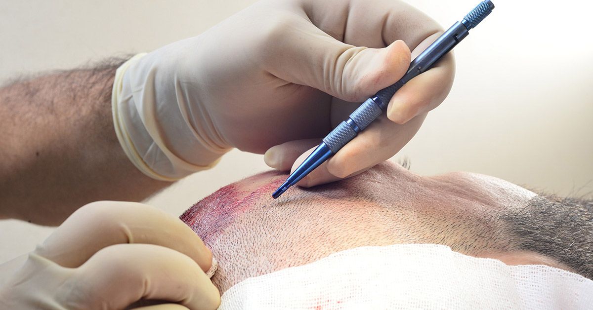 How Much Does a Hair Transplant Cost? Complete Price & Graft Breakdown 1 Hair Transplant Cost Malaysia — Complete Price & Graft Breakdown