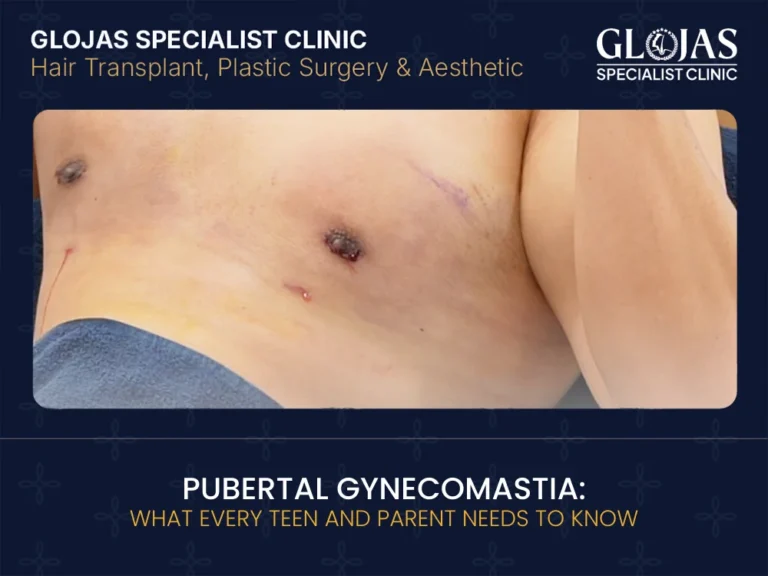 pubertal-gynecomastia