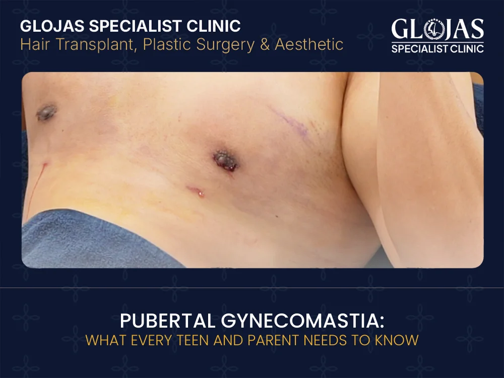pubertal-gynecomastia