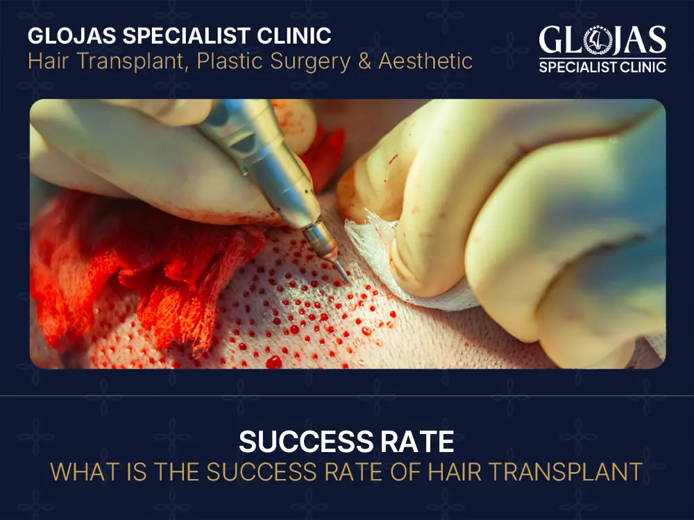 success rate hair transplant