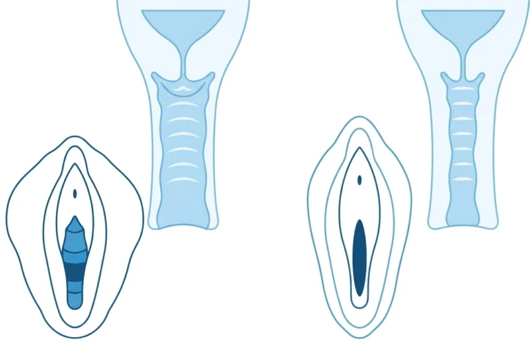 Vaginal Tightening Malaysia