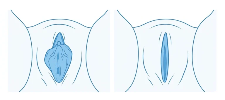 before and after vaginal tightening photos 1