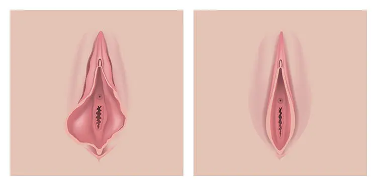 before and after vaginal tightening photos