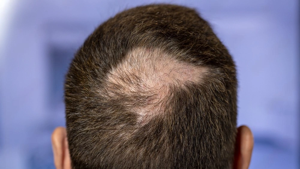 how to prepare for a hair transplant