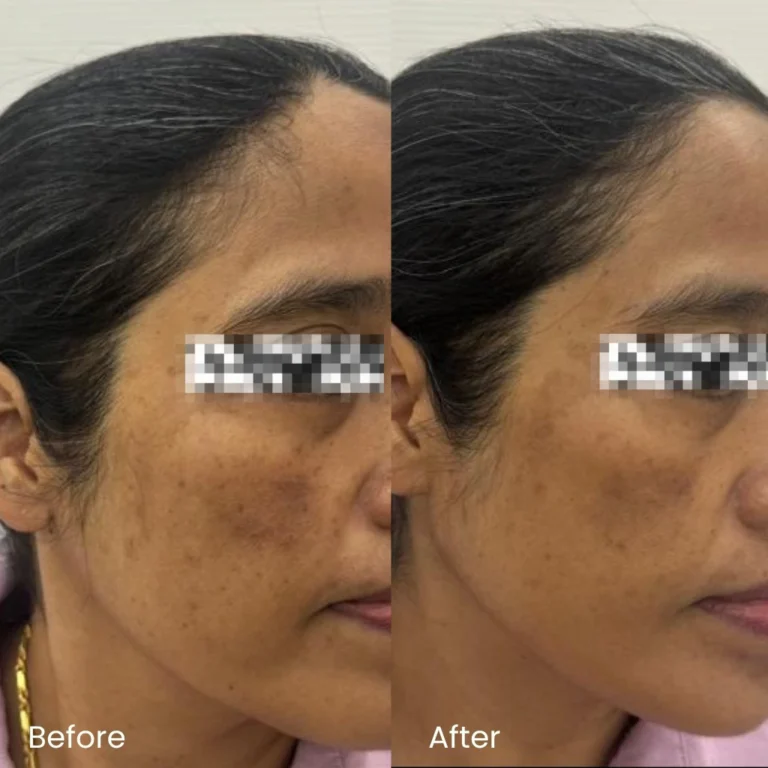 Pigmentation Treatment Ads 4 pigmentation_review1