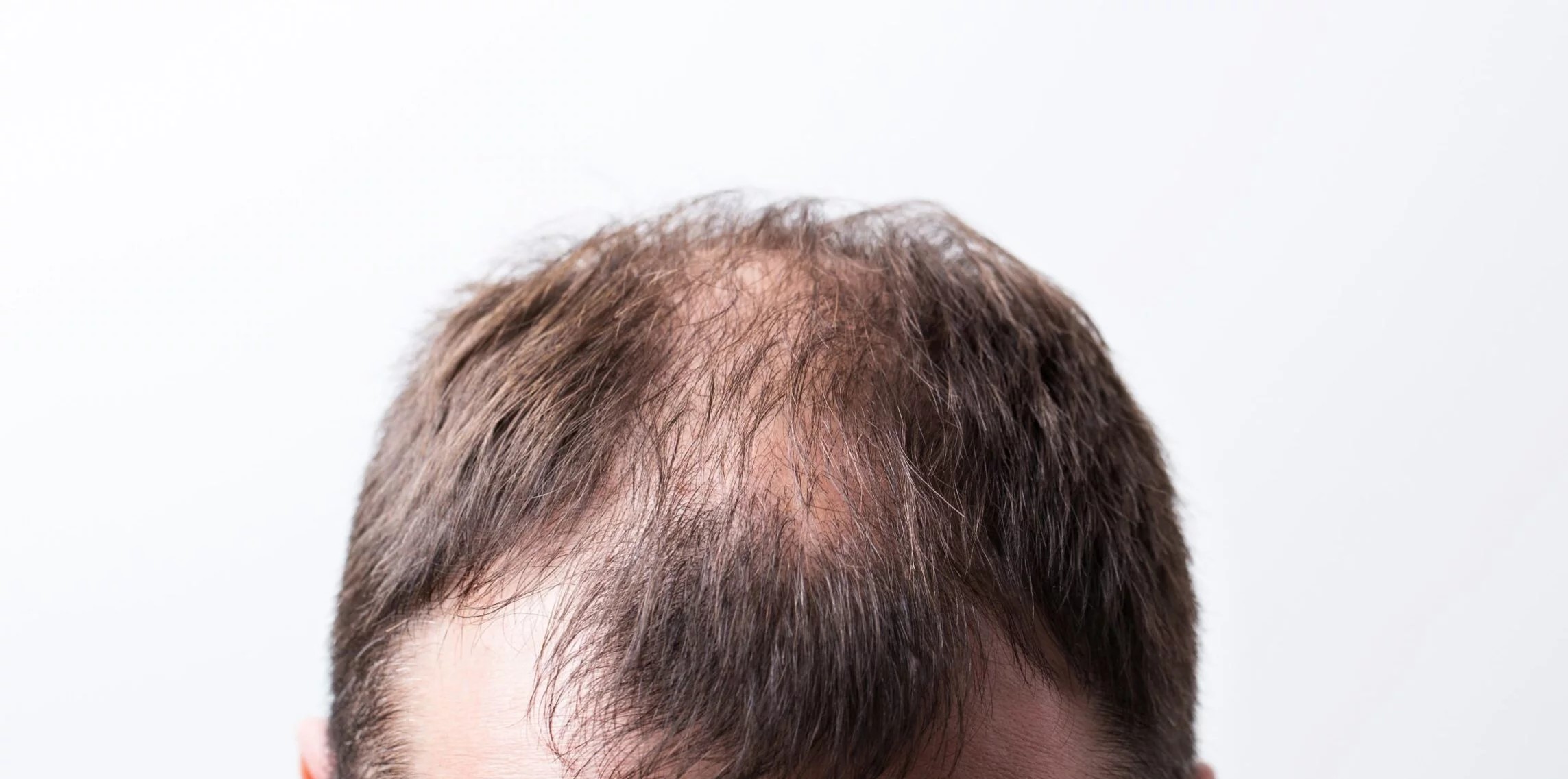 unshaven hair transplant in malaysia