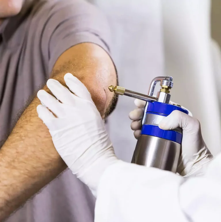 Cryotherapy (Liquid Nitrogen Freezing)