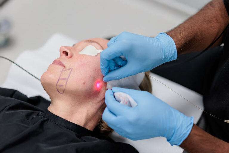 Endolift facial contouring procedure