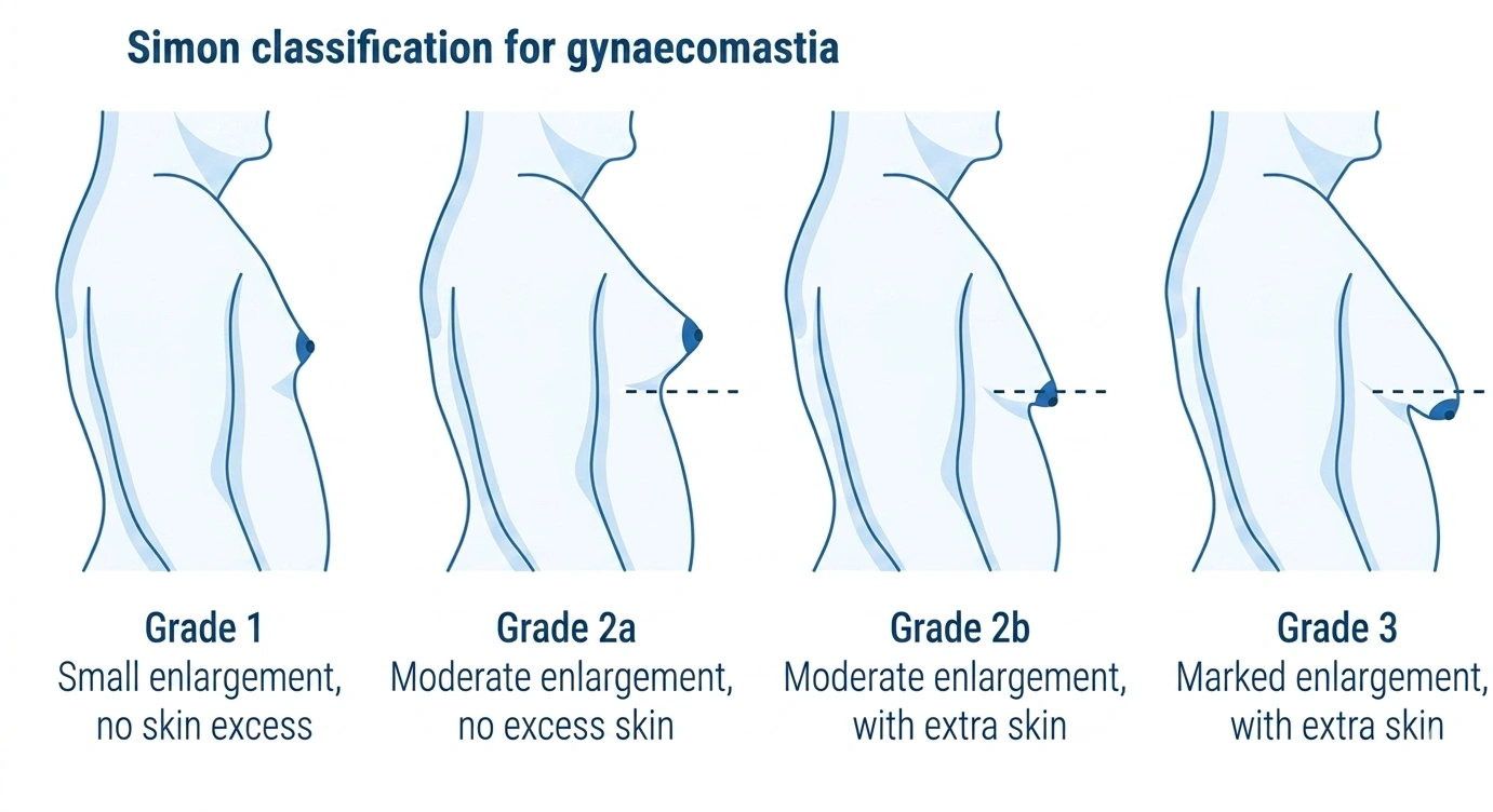 Gynecomastia Grades Types and Severity Explained