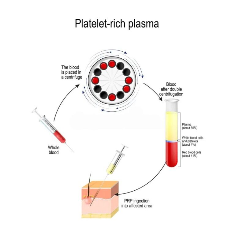 Platelet-rich plasma face treatment for skin rejuvenation