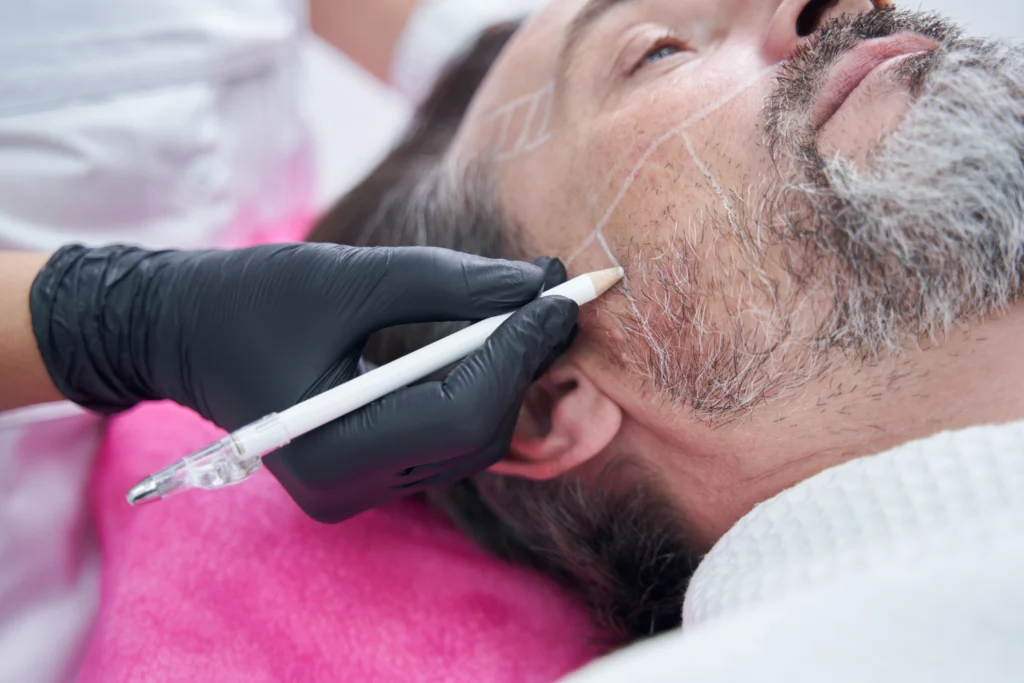 beard_transplant