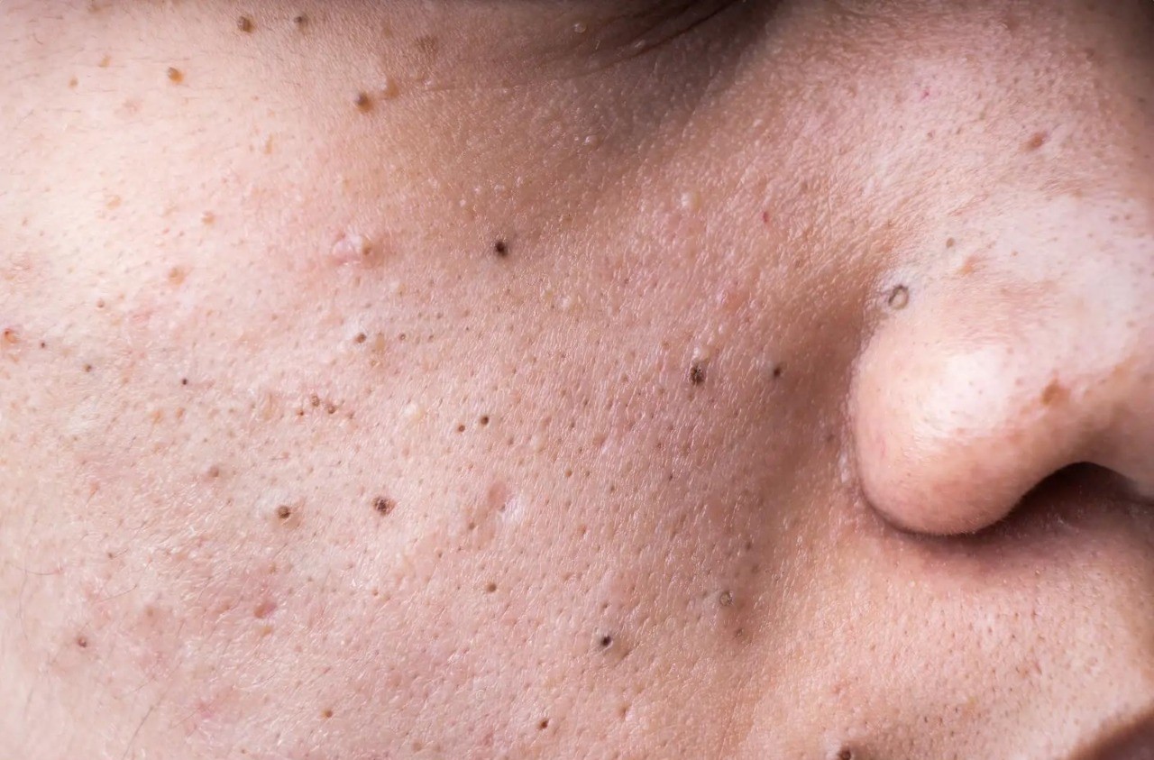 Blackheads: Causes, Removal Treatments & Prevention Tips 1 Blackheads – How to Clear Clogged Pores for Good