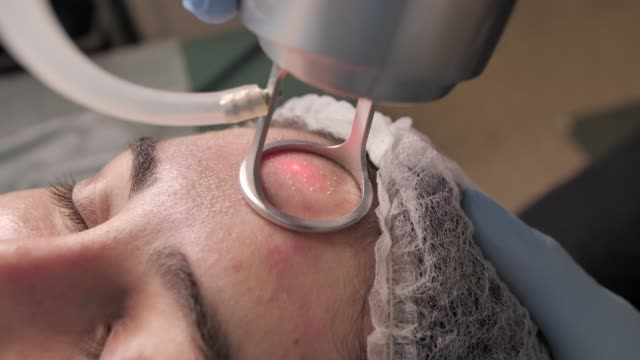 fractional co2 laser