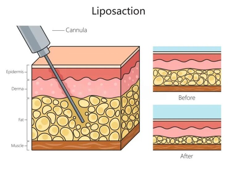Liposuction Cost in Malaysia | Average Prices & Factors 2026