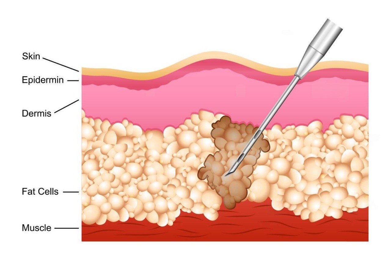 Liposuction Side Effects in Malaysia: Risks, Safety & Recovery Guide