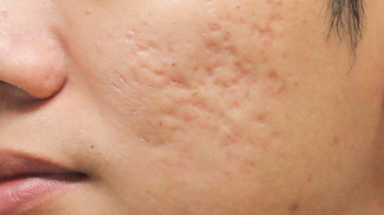 box scars subcision