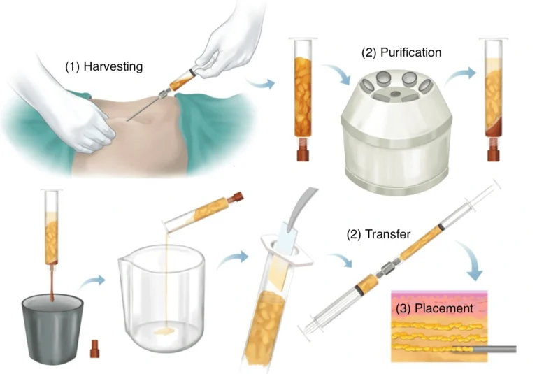 fat transfer malaysia